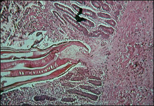20110306-Hookworm cdc  hookworm_intestine.jpg